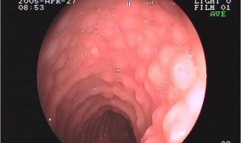 Duodenitis nodular