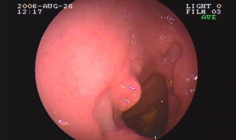 Duodenitis por CMV en paciente inmunodeprimido