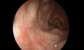 Gastritis eosinofílica