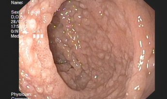Duodenitis por Giardia Lamblia