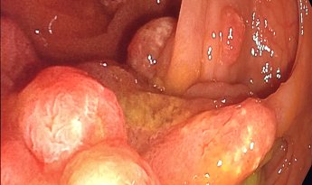 Multiples pólipos planos y pediculados en colon ascendente.