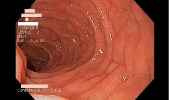 Enfermedad celiaca
