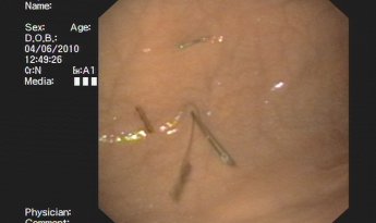 Gastropexia y gastrostomía percutánea